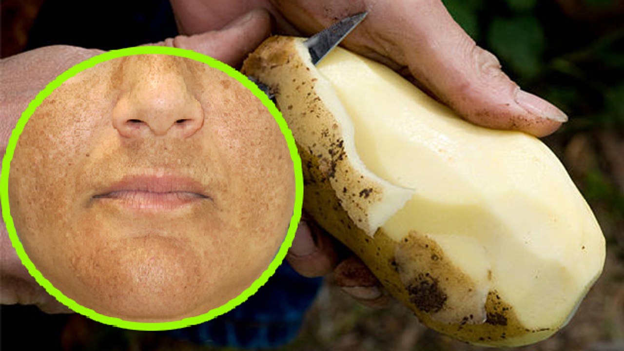 चेहरे पर आलू लगाना चाहिए या नहीं | Face Par Aalu Lgana Chahiye Ya Nahi | Boldsky *Health