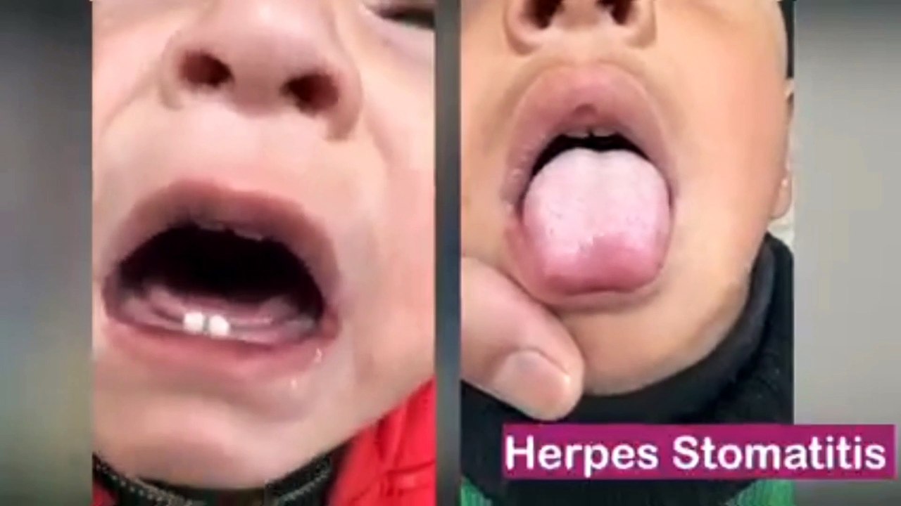 Two types of ulcer in babies