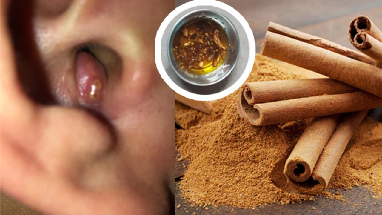 कान में फुंसी होने पर क्या करें | Kaan Ki Funsi Door Karne Ke Tarike | Boldsky