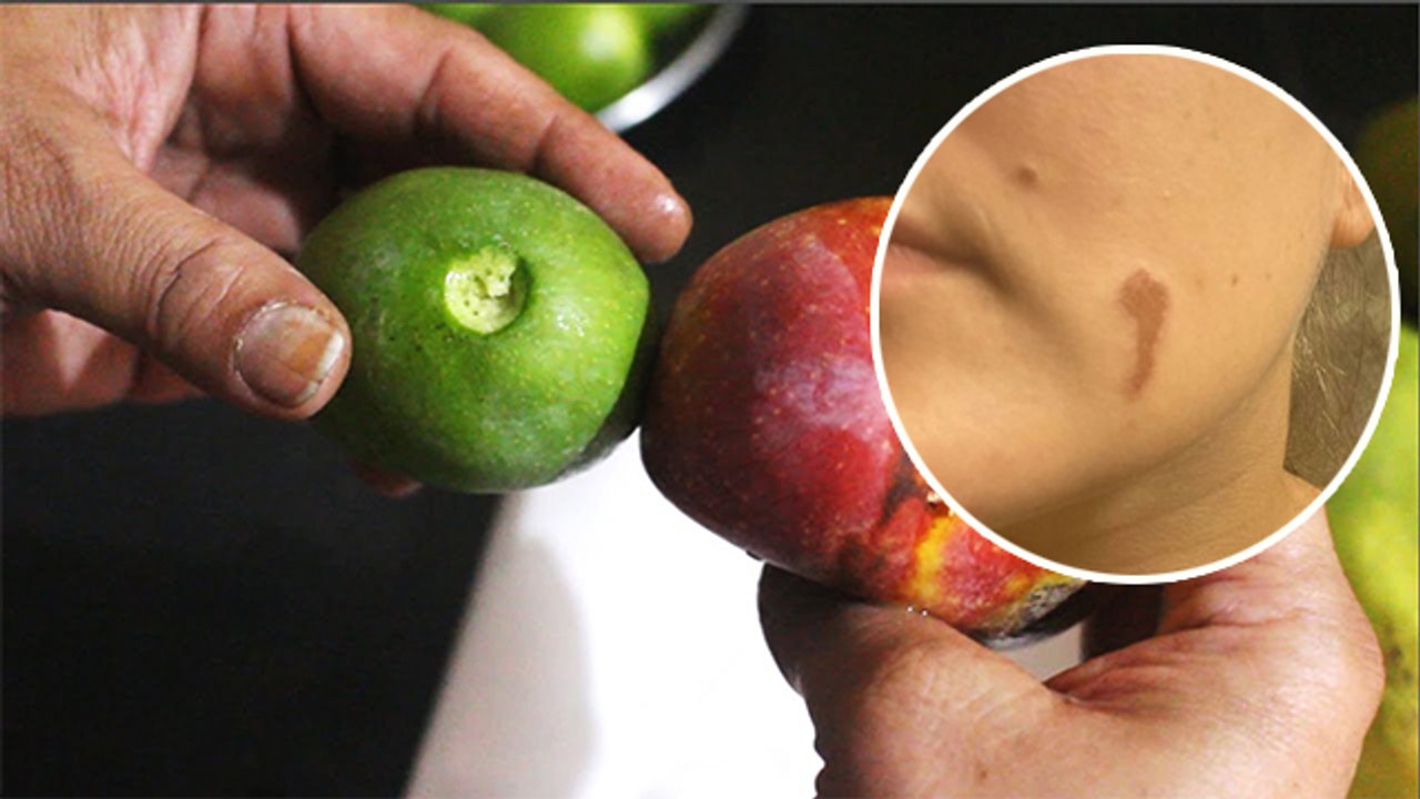 Aam Ki Chopi Ke Daag Kaise hataye Chehre Se | आम की चोपी के दाग कैसे हटाएं चेहरे से | Boldsky