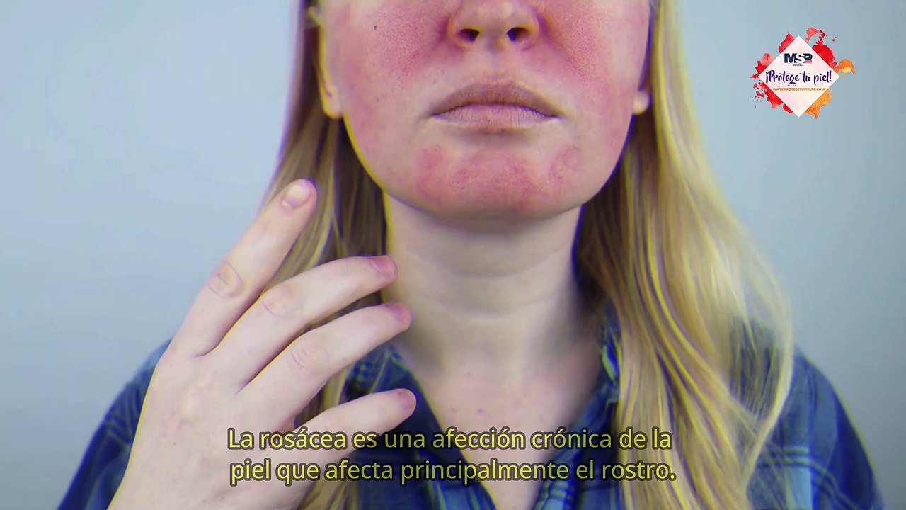 ¿Cómo funciona la rosácea? - #ExclusivoMSP