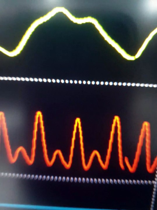 Patient Monitor with Multiple Parameters