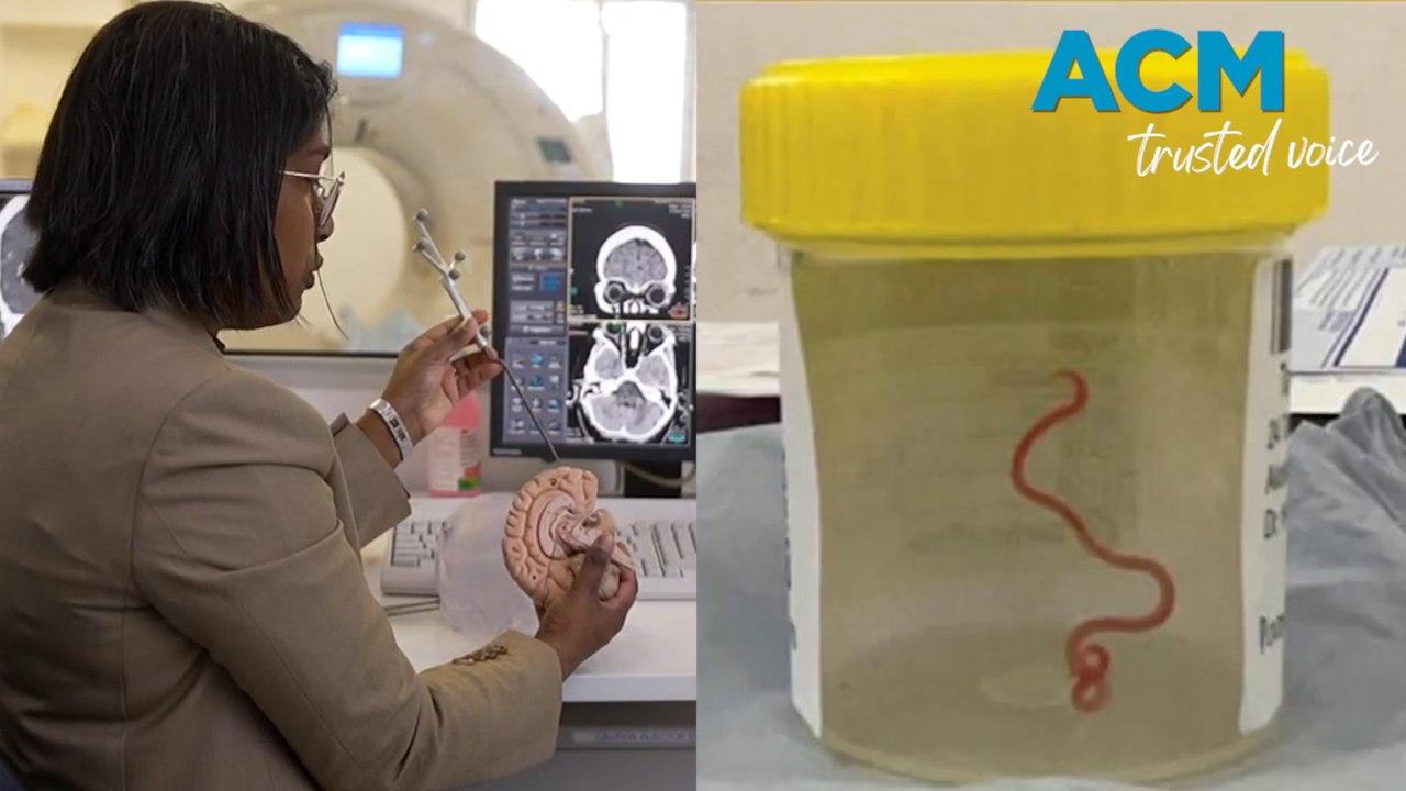 Live parasitic worm found in Aussie woman’s brain in world first