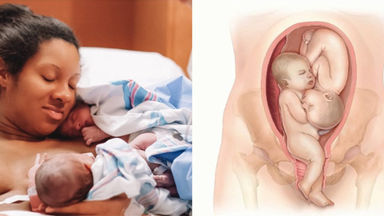 Twin Pregnancy Me Normal Delivery Possible है या नहीं, EXPERT ADVICE | Boldsky