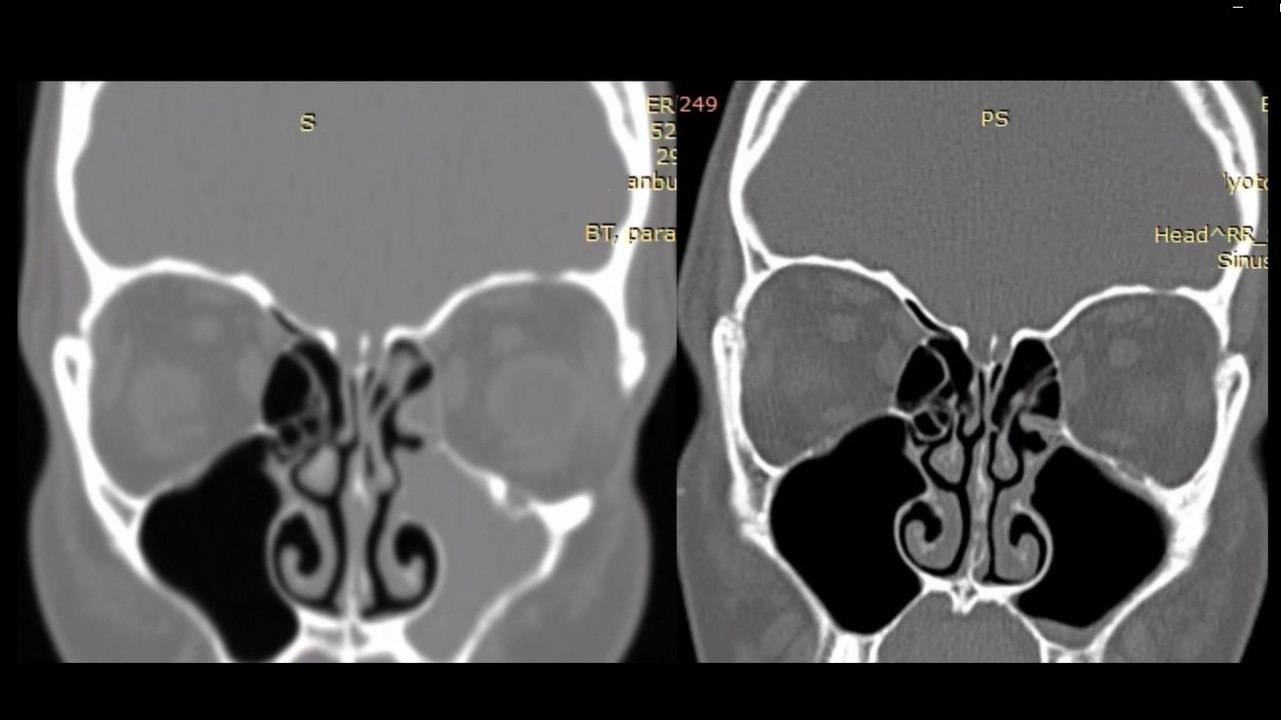Should we trust every sinus tomography? / Sinüs Tomografisinin Yorumlanması