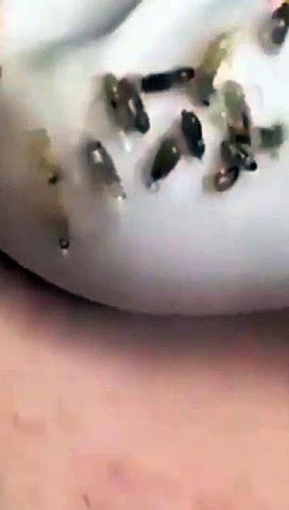 Cheeks blackhead removal   Satisfying   blackhead ASMR #blackheads #asmr #satisfying