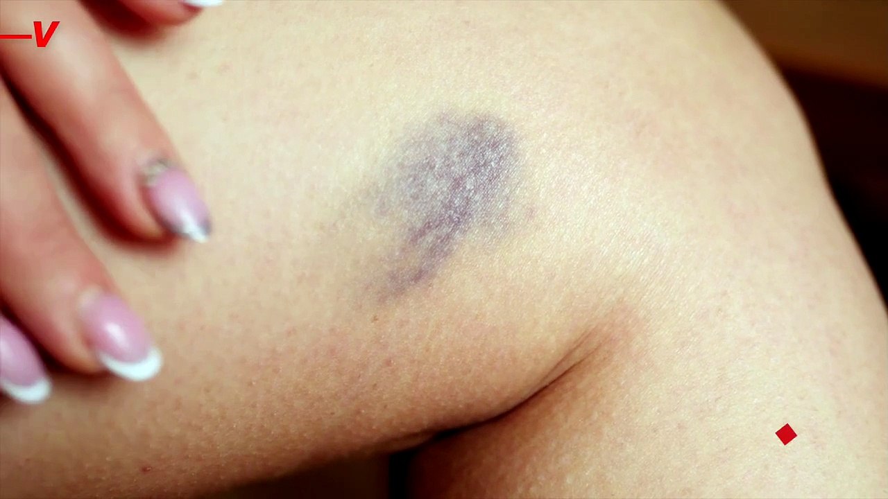 Why Do We Bruise Easily? Understanding the Causes and When to Worry
