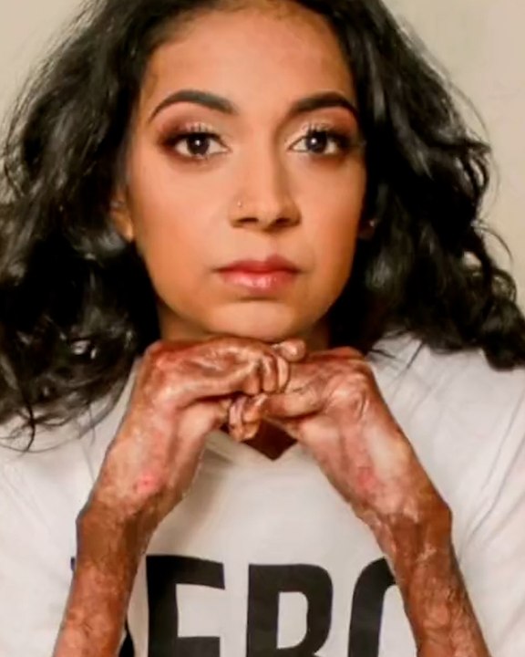 Growing Up With ‘Butterfly Skin': Meet the Woman With Skin as Fragile as a Butterfly’s Wings