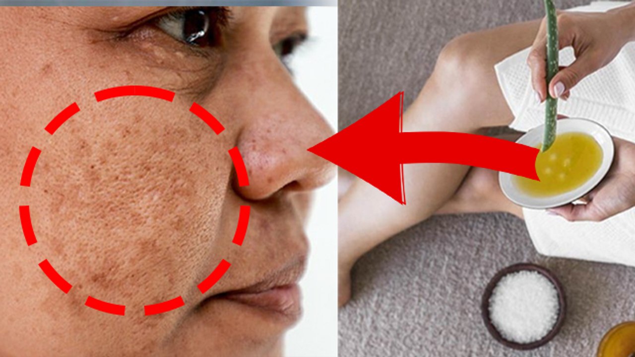 आलू से झाइयां कैसे हटाएं | Aloo Se Chehre Ki Jhaiya Kaise Hataye | Boldsky