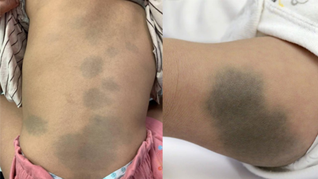 Newborn Baby Body Black Blue Spots Reason, Pediatric Metabolic Disorder Symtoms |Boldsky