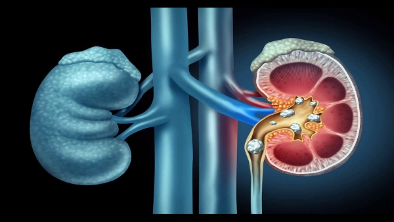 وصفات طبيعية لعلاج حصوات الكلى