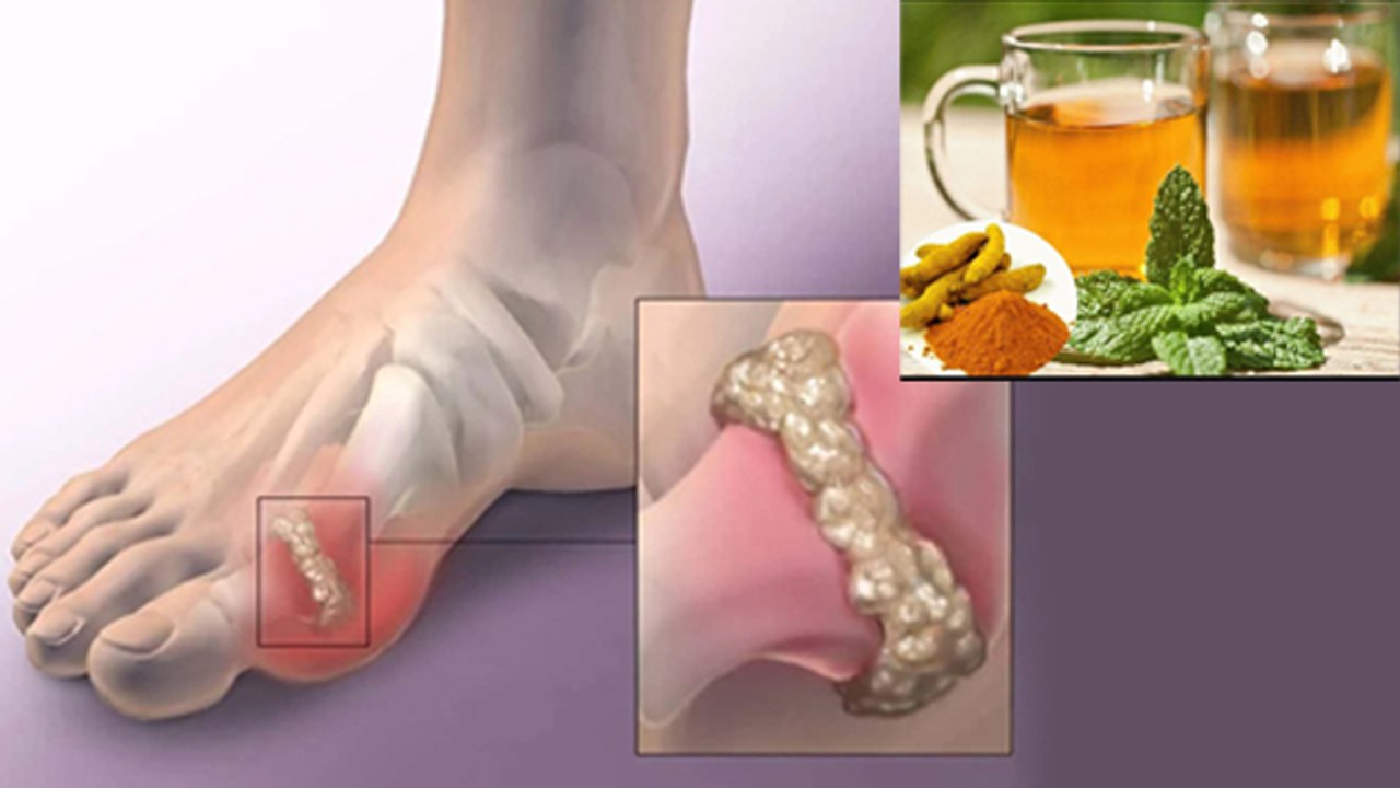 हल्दी और तुलसी से हाई यूरिक एसिड कम करने का तरीका | High Uric Acid Kaise Kam Karen | Boldsky