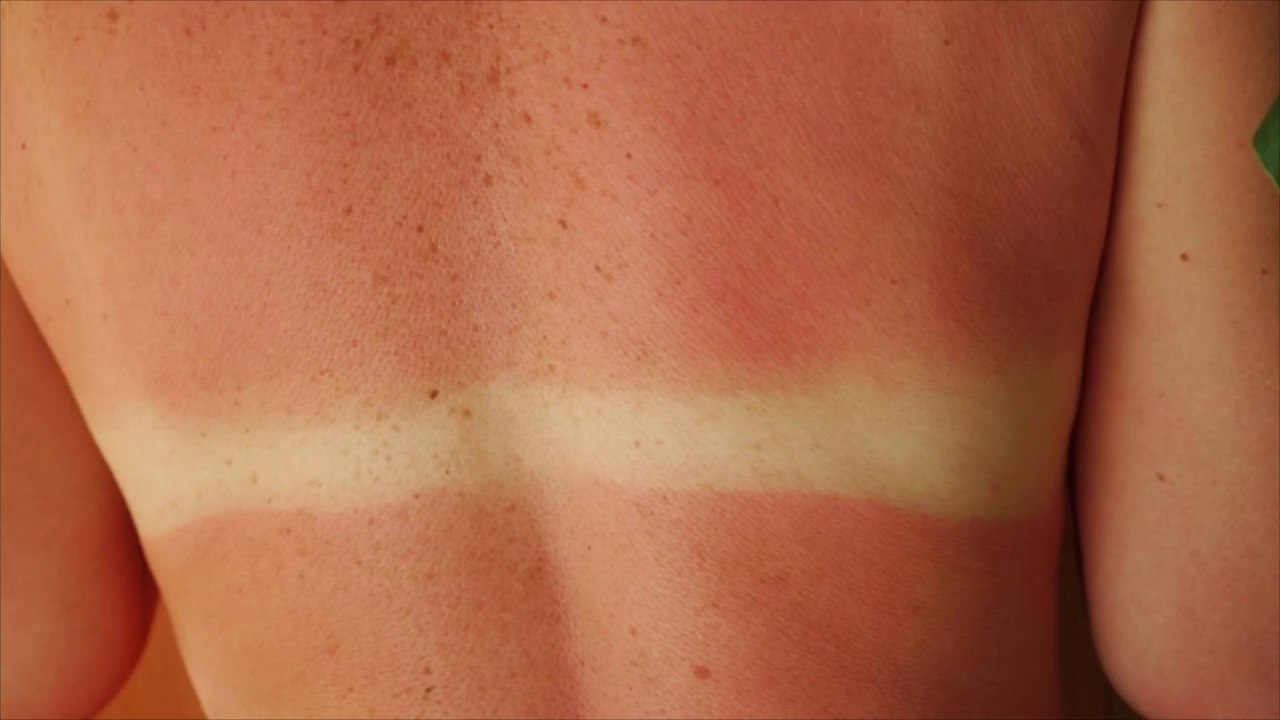 Research Indicates Sunbathing May Affect Your Microbiome