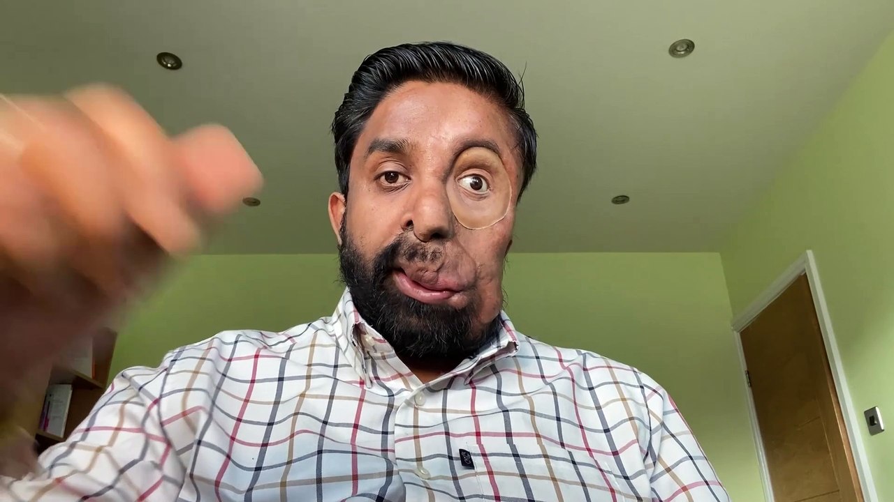 Bullied man with facial difference quits job to tour schools to help kids