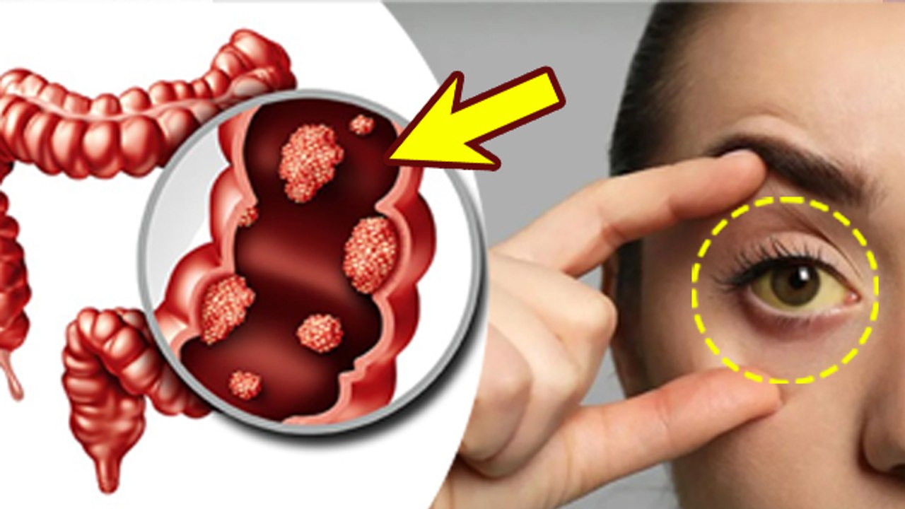 Small Intestine Cancer Symptoms: Causes & Treatment In Hindi| छोटी आंत में कैंसर के लक्षण |Boldsky