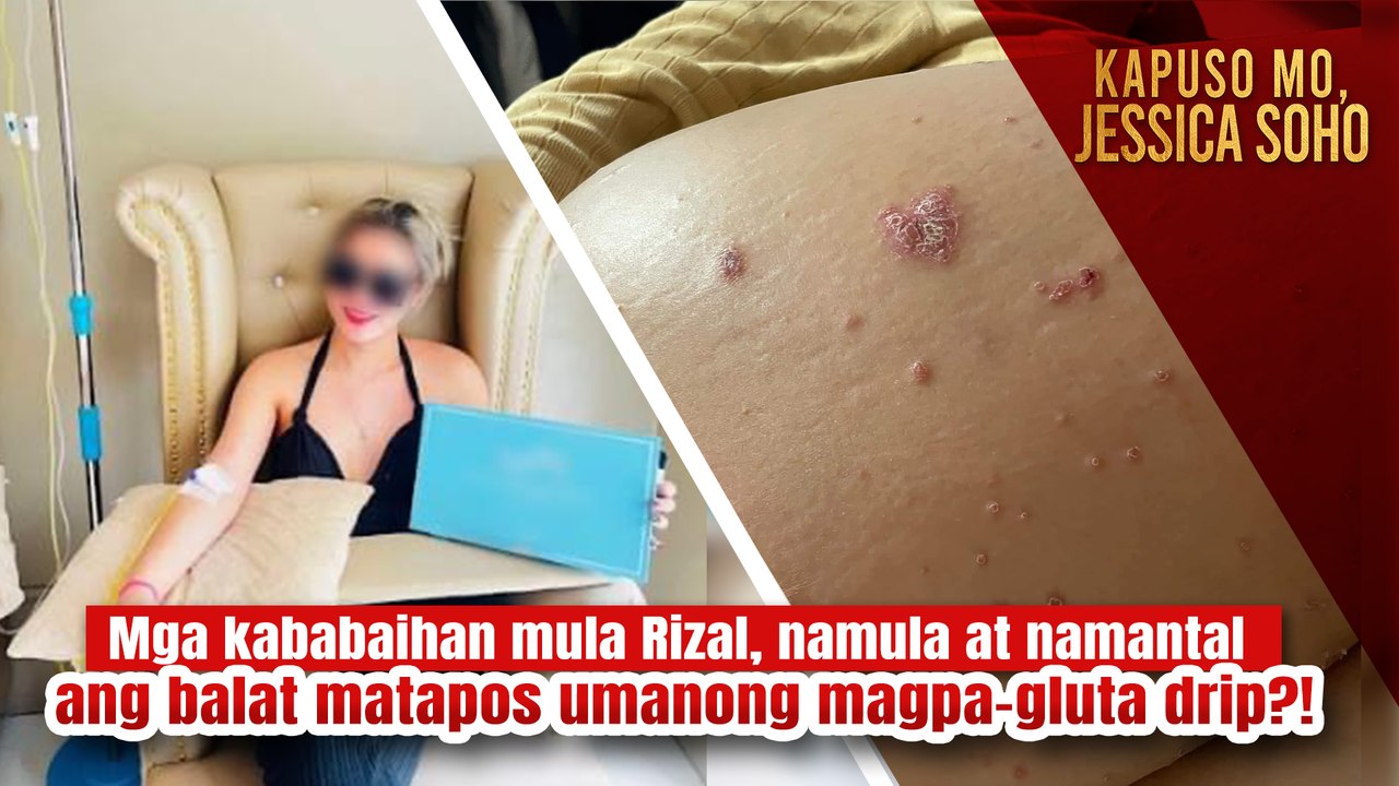 Mga babae, namula at namantal ang balat matapos umanong magpa-gluta drip?! | Kapuso Mo, Jessica Soho