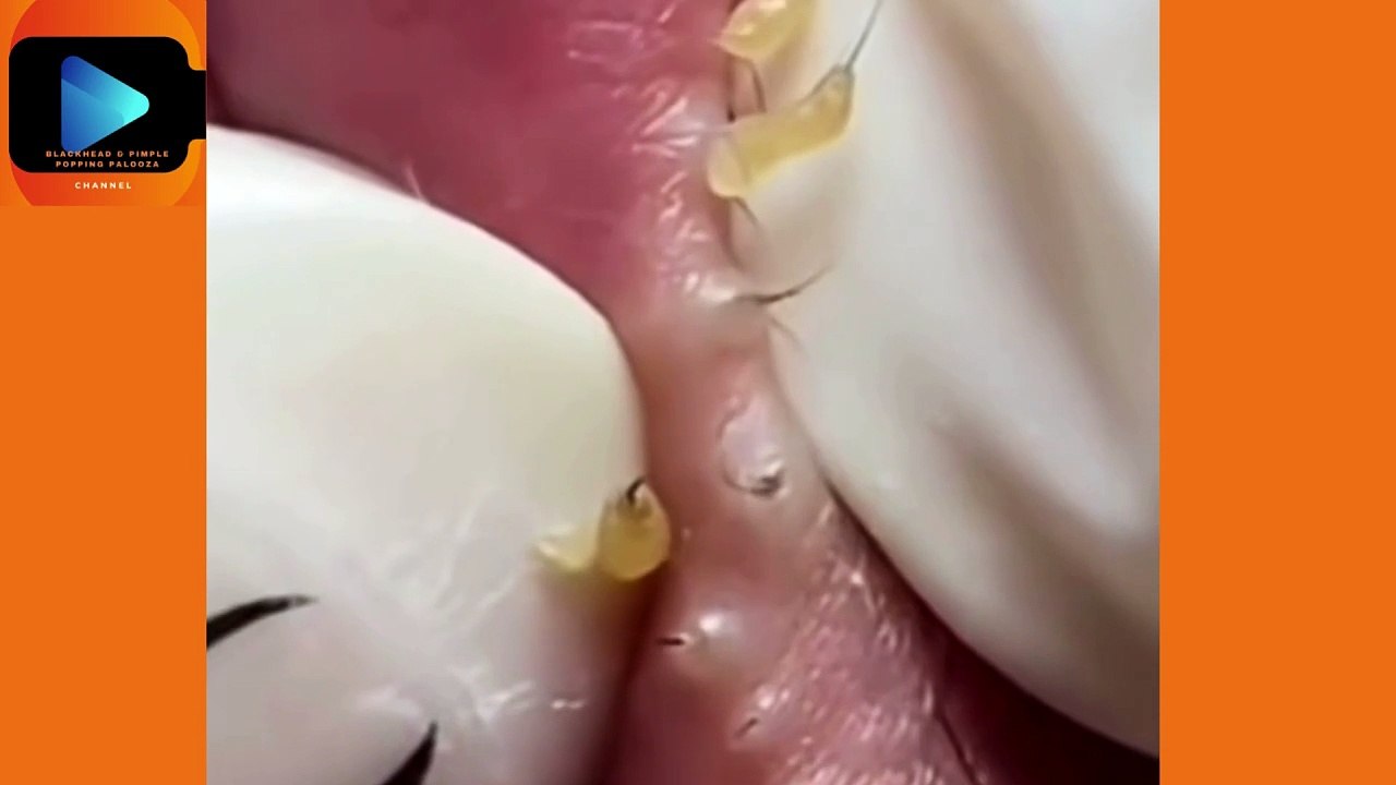 Strangely satisfying, pimple-popping extravaganza!