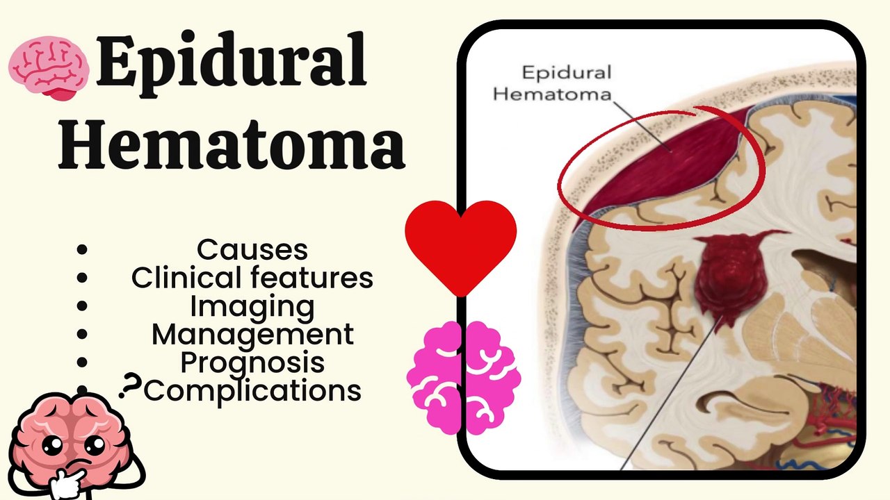 Epidural Hemorrhage Explained: Causes, Symptoms, Diagnosis, and Treatment