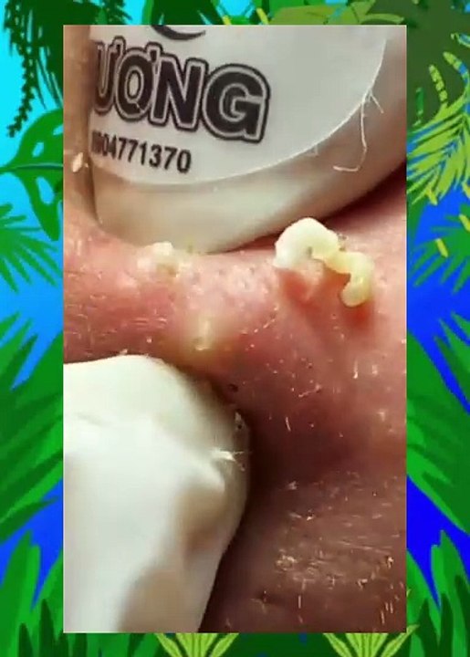 ASMR Deep Pore Cleansing Facial: Blackhead & Acne Extraction Therapy