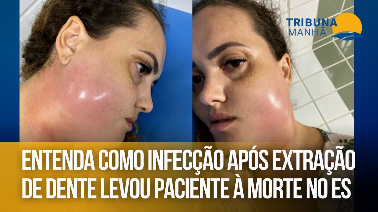 Entenda como infecção após extração de dente levou paciente à morte no ES