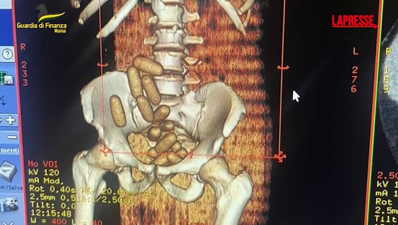 Roma, ingerisce ovuli con oltre 280 grammi di cocaina: arrestato