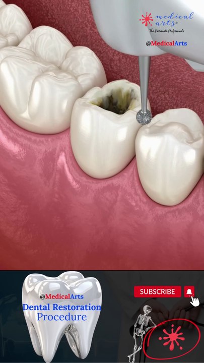 Dental Restoration ↪ Composite Bonding Teeth  ↪ 3D Medical Animation