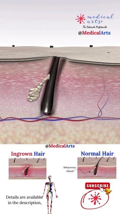 Ingrown Hair ⨖ Laser Treatment ⨕ Medical Arts 3D Animation