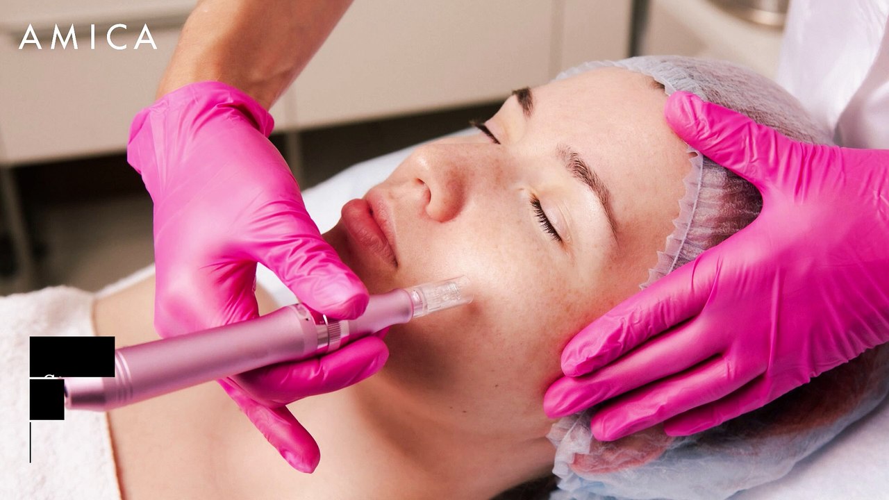 Microneedling, come funziona il trattamento “booster” per la pelle?