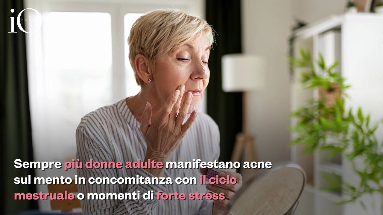 Acne sul mento, perché compare e come liberarsene