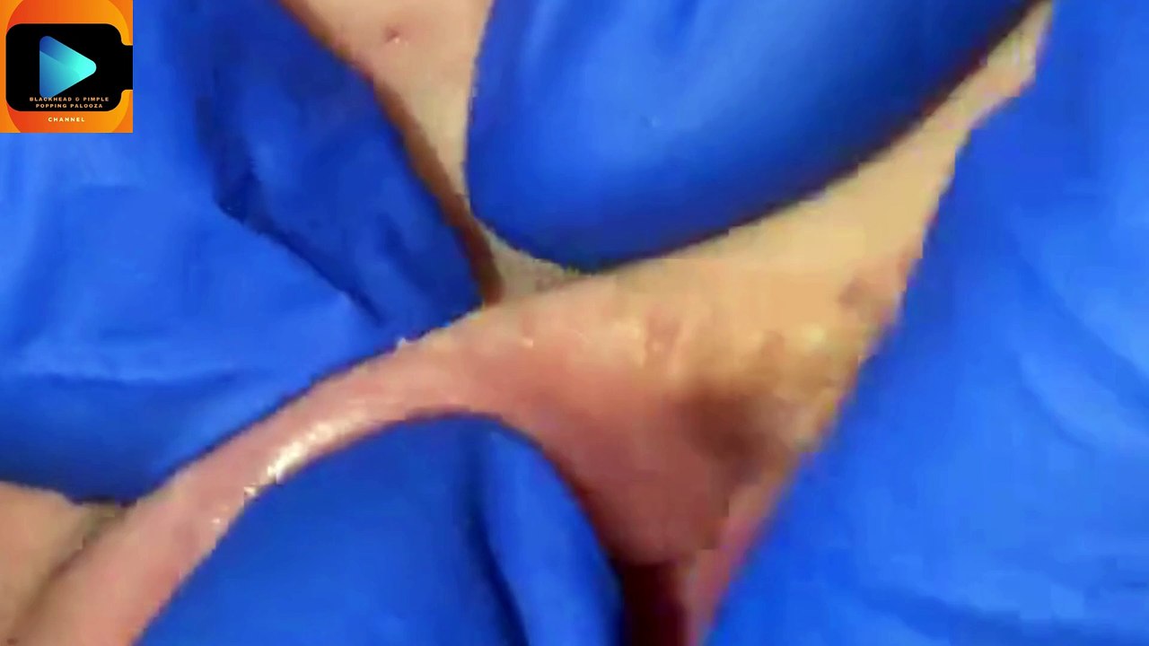 Deep Blackhead Removal from Upper Lip & Cheeks – Satisfying Extractions!