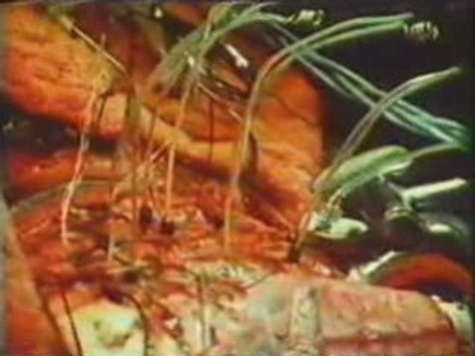 Estimulacion electrica cerebral (Neurocirugia)